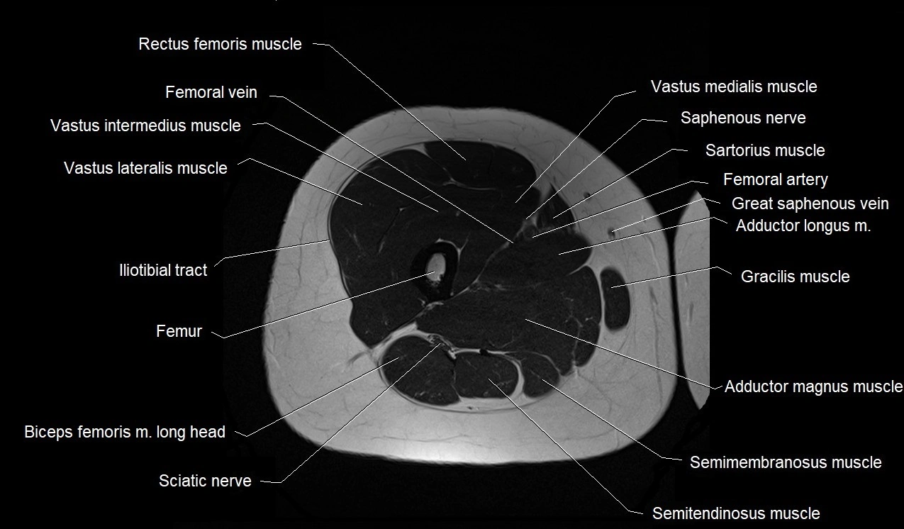 MRI thigh cross sectional anatomy image 27.webp